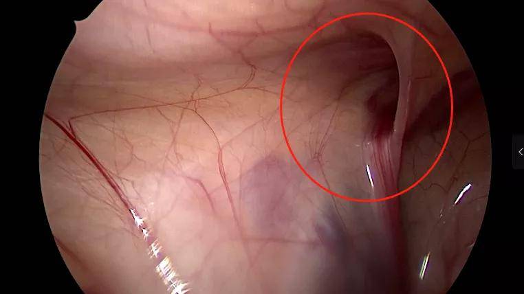 时间|小儿疝气手术，做了24小时就可出院？