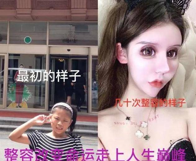 13岁女孩“整容上瘾”3年整了60多次如今“画风”不忍直视(图3)