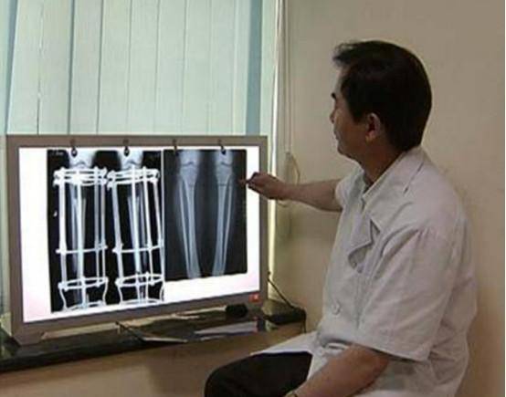 李亚诺|当年那个花了16万，断骨增高7.2厘米的男生李亚诺，后来怎么样了