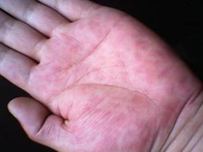 肝脏|肝脏发生病变,身体会以5种方式“抗议”?请你早发现早处理