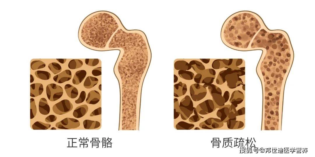 症状|腰背痛、易骨折……这种“无声无息的流行病”，每个人都应该重视起来！