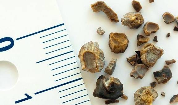 肾脏|不想被肾结石“缠上”?碰到这3种食物,再爱吃也要适量