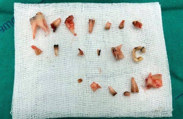 原创4岁孩子一口烂牙麻醉全拔光想想就疼这件事家长真的别再拖了