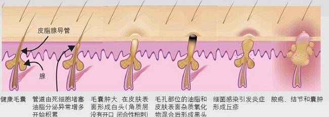 祛痘|油皮洗面奶哪个牌子好用？油皮最爱的洗面奶，控油祛痘一把抓