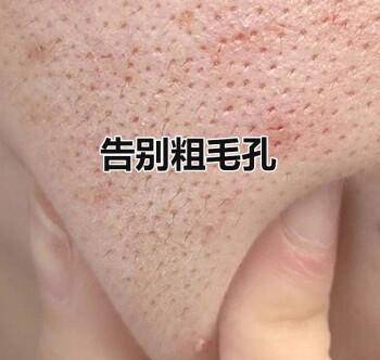 因为|毛孔粗大爱长痘痘？是否“螨虫”在作怪？要看脸上有这些感受没有