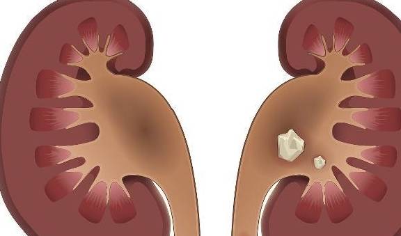 转氨酶|夏季肾结石高发，8个报警信号你收到了吗？