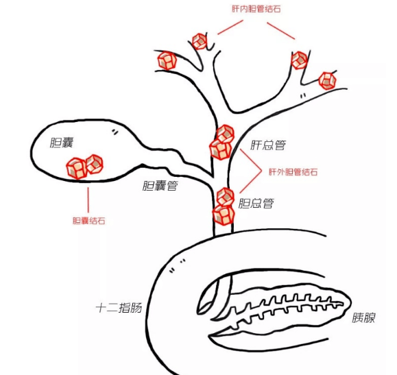 甚至無創!逆行胰膽管造影術取膽總管結石