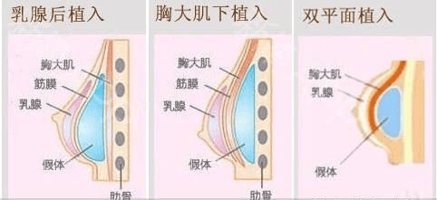 胸部|李朕（李春财）浅谈：隆胸自体好还是假体好