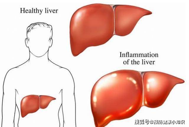 人体|早起坚持做5件事，肝脏一辈子没毛病，有肝病也不轻易恶化