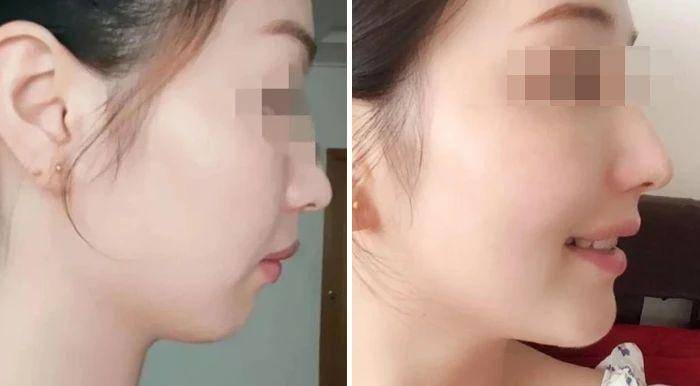 龅牙|广东省全民爱牙行动 地包天需要正畸正颌联合治疗