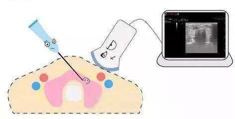 医学|超声科医生的手术——介入超声你了解吗？