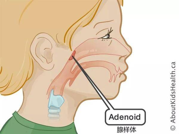 打呼嚕口呼吸的孩子可能是腺體肥大影響面容身高免疫力