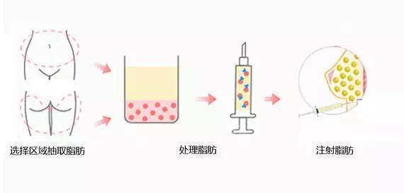 面部|自体脂肪填充面部多久恢复自然？说7天就恢复的确定没吹牛？