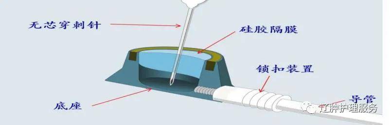 胸科医院|西安市胸科医院成功开展首例手臂输液港技术