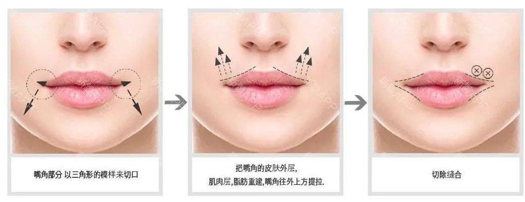 调整|嘟嘟唇、水光唇，告别盲目跟风，唇部可做医美大合集~