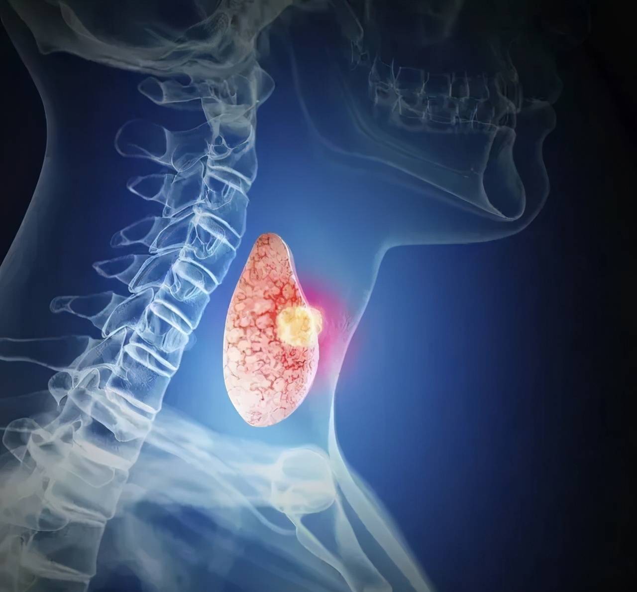 治疗|云南中西医结合医院甲状腺专科：做好这5点，可有效预防结节不复发