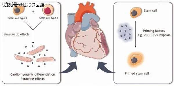 干细胞治疗心肌梗死