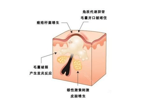 毛孔|佰花方：油痘肌夏日生存指南，让你30s了解并KO它