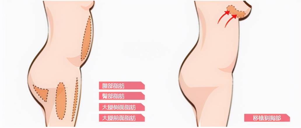 部位|实力diss：隆胸自体脂肪，抽脂隆胸的价格是多少？变美先了解！