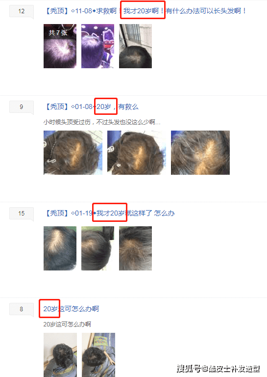 18岁掉头发厉害怎么办