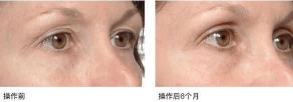 源自于骨面而止于皮肤的韧带有着直接的关系,并且融合了组织容量减少