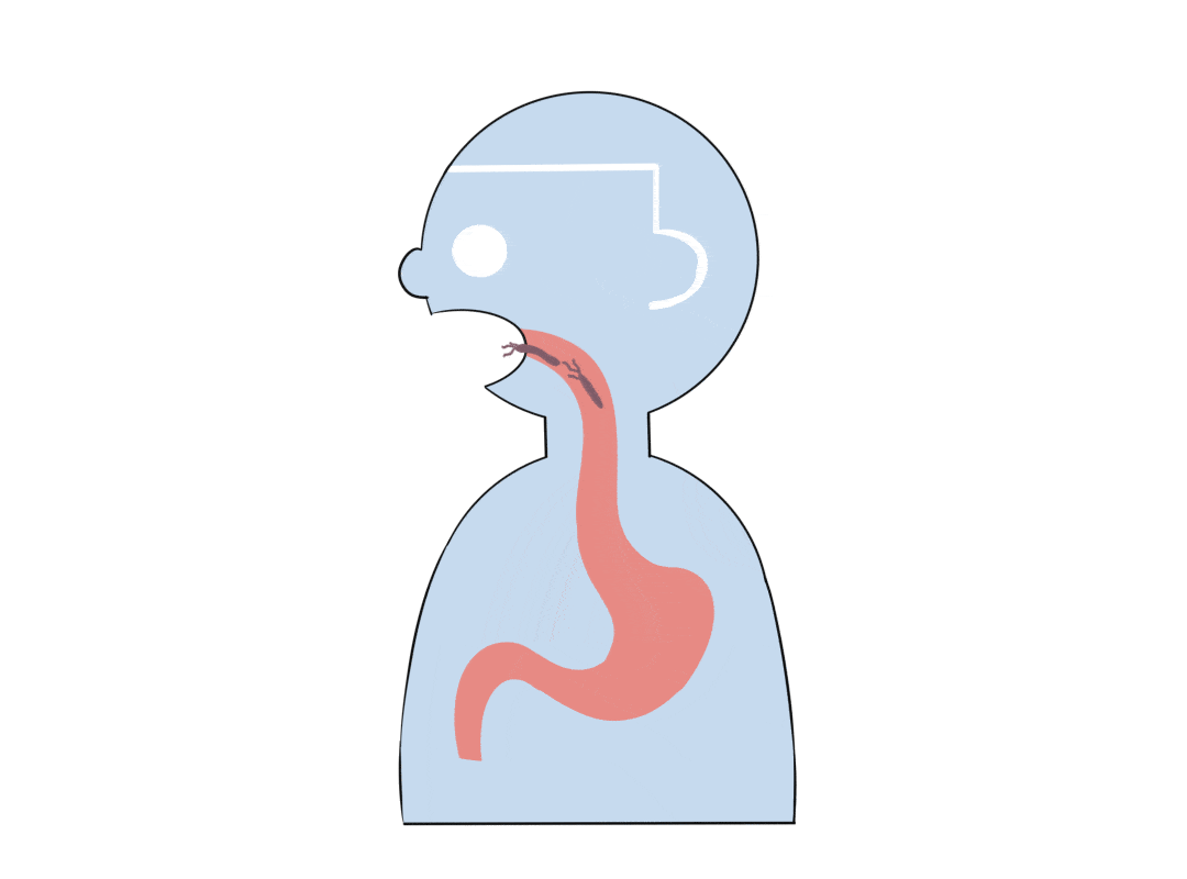 筛查|一人中招全家感染！传播幽门螺杆菌，全在这4个动作里！