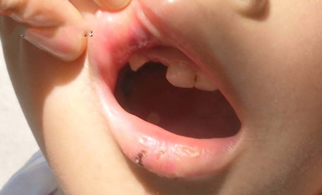 要求|贵阳：孩子在幼儿园磕断牙，家长要求种植牙齿，园长：换牙期