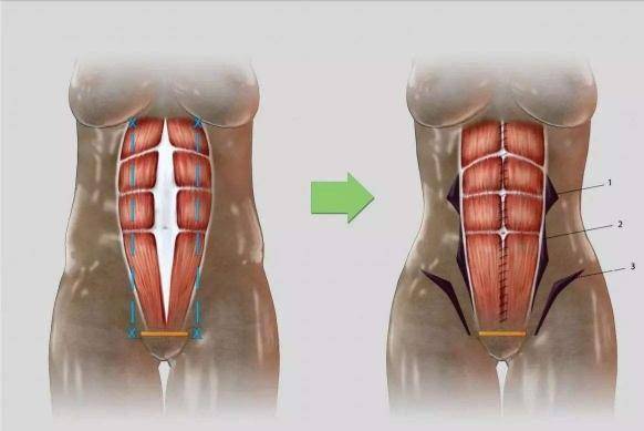 自己怎样测腹直肌分离 7f215e99a3ee4977ac2e55de9bdd6022.jpeg