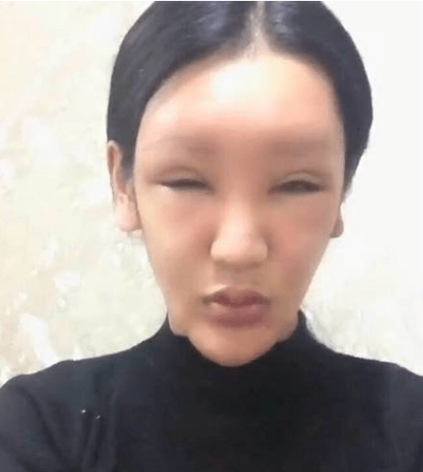因为|女网红注射奥美定8年后爆发问题，额头内部溃烂，透露胸和屁股都曾注射奥美定