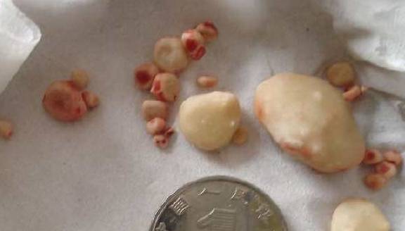 气血|肾结石可以这样去掉!大部分人都不知道