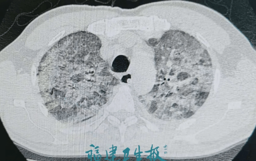 阿姨|可怕！2人高烧不退，核酸阴性！近期千万当心！