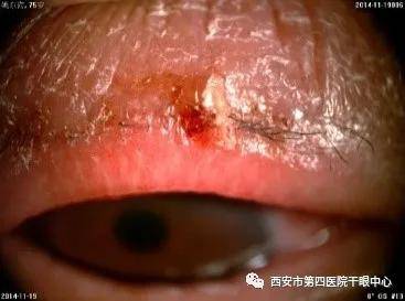 局部|【医学科普】总是眼痒、眼干、流泪？三种治疗方式来了解！