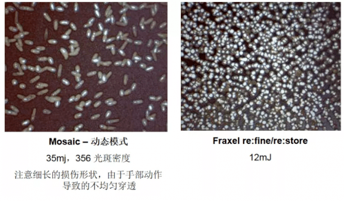 点阵|热玛吉同门姐妹：飞梭镭射Fraxel美白、缩毛孔绝了！