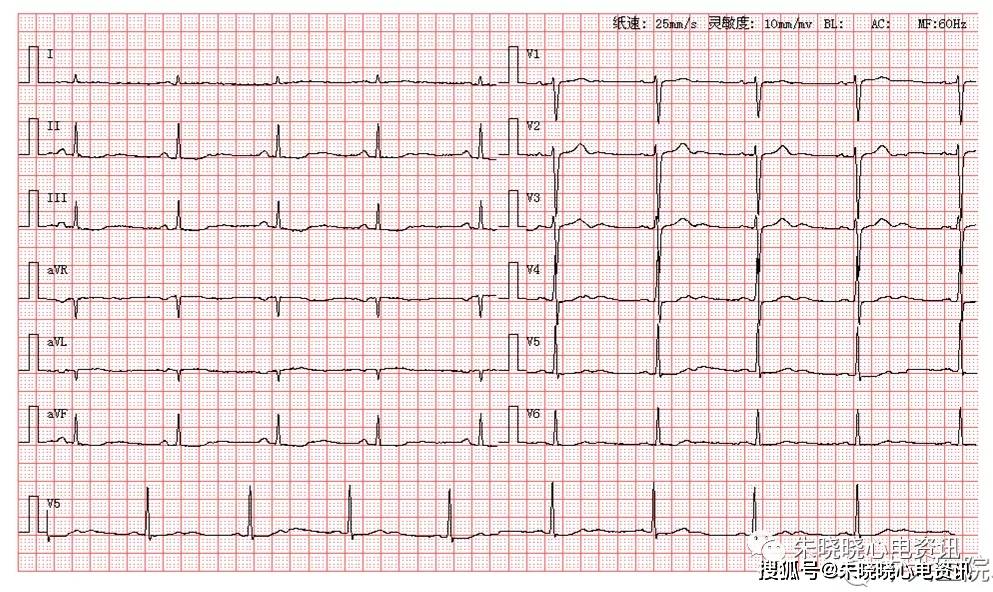 患者女,54岁,因胸闷心悸来医院就诊,图为其入院体检心电图