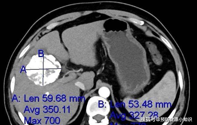 毒素|误认为皮肤过敏，查出肝癌！提醒：皮肤3种异常，肝或已“烂如蜂窝”