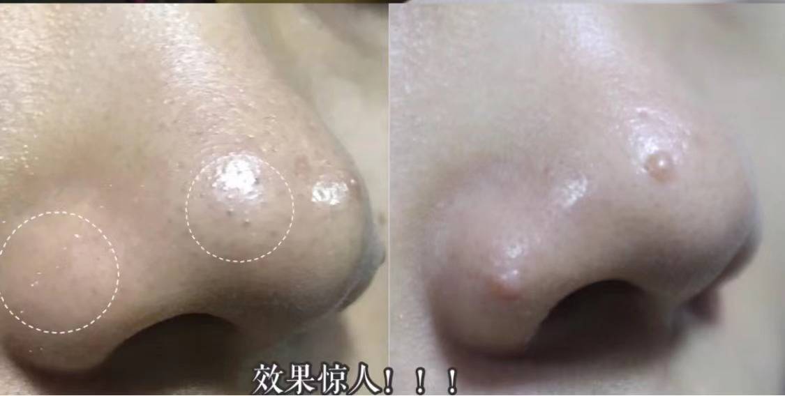 水箱|年轻人第一台毛孔“吸尘器”，要想干净洁白不用刷酸，3次见效