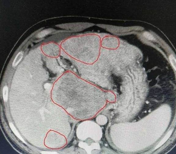 肝脏|医生提醒：肝硬化，并非毫无踪迹，身体出现4异常，劝你早查肝功