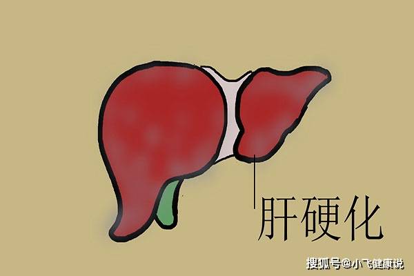 治療|肝若硬化了，前2個月身體一般就有提示，別等拖到晚期才后知后覺