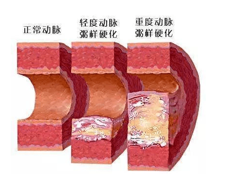 模型|炎症的危害你了解吗 芝麻素的抗炎机制