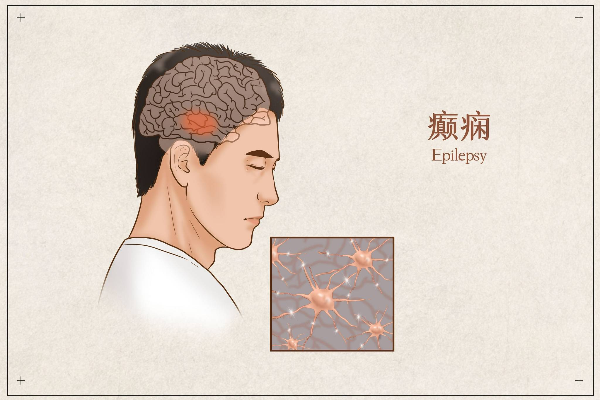 疗法|东莞市第八人民医院：大咖“痫”聊——迷走神经刺激疗法