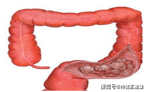 原创体内肠癌身体先知若出现这种现象或是大肠癌来报到