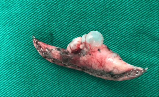 青年男性,发病前多有搬动重物,剧烈咳嗽,用力排便等诱因,导致肺泡破裂