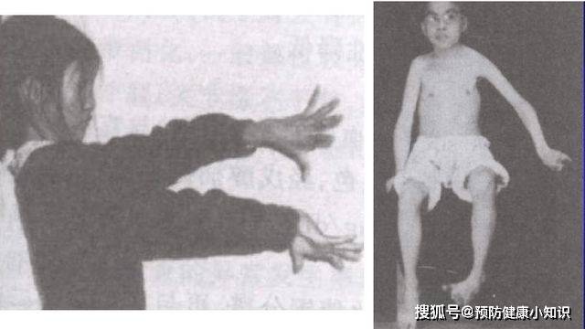 症状|肝豆状核变性是一种先天疾病,有家族史者,应进行基因检测