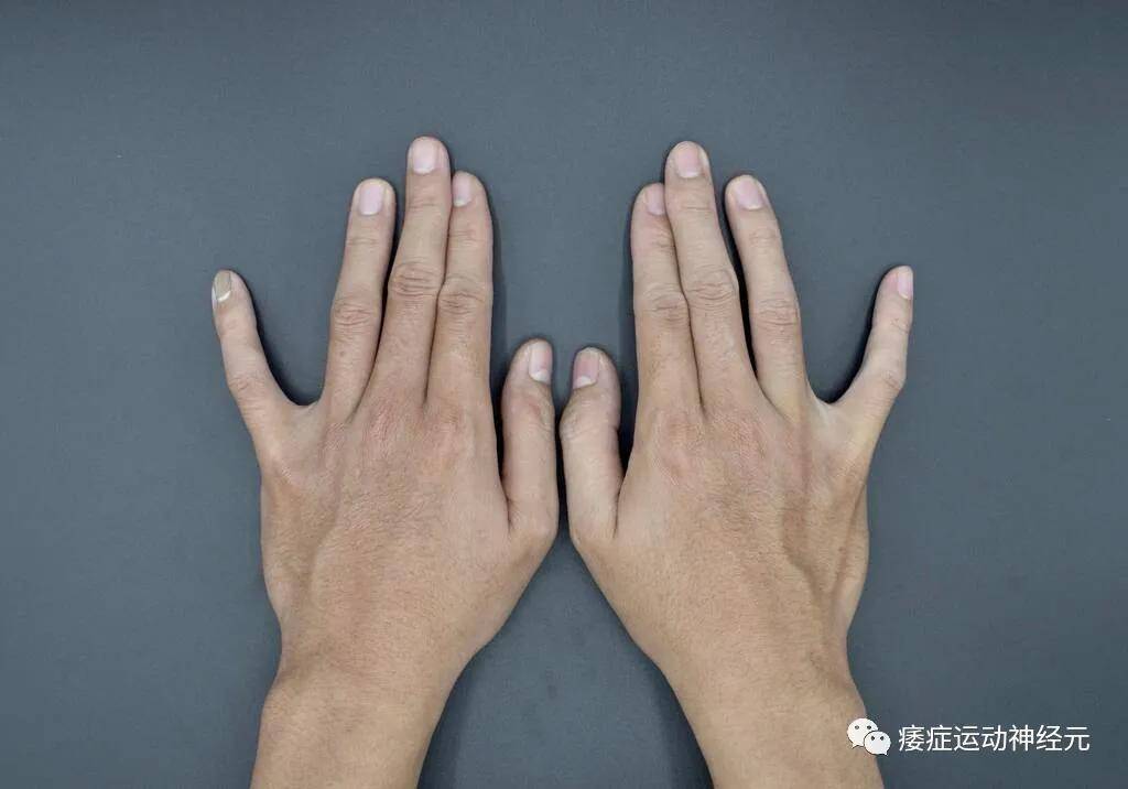 症状|运动神经元病会给身体带来什么样的危害-看后吓一跳