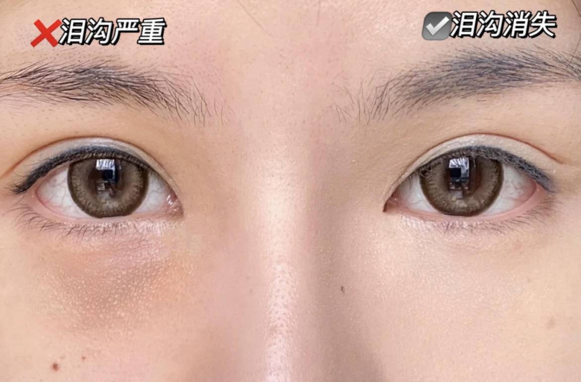 产品|万年的黑眼圈跟泪沟消失术！