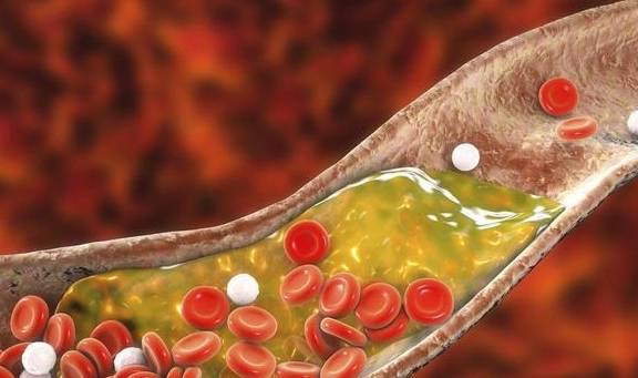 血管|脑梗死的人，容易再次复发，医生告诉您：只有这样才能预防复发！