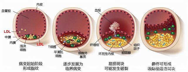 原创血管斑块是怎样形成的有没有预防斑块的办法