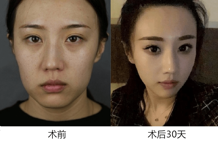 什么|面部抗衰 线雕适合哪些人做？禁忌是什么？线雕修复有多难？