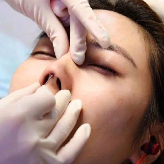 张力|五官C位可不能随便动,鼻综合也不是人人适合!