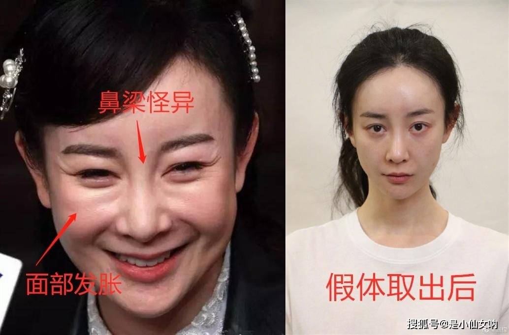 李小璐|10位“整容上瘾”的女星，明知硅胶脸恐怖，为何还是前仆后继？